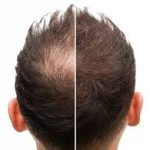 پری کشاورز درمان ریزش مو در شیراز قصر دشت